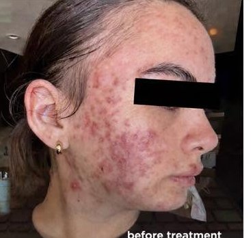 Before treatment — right profile