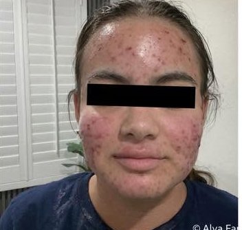 After treatment 1 — front view