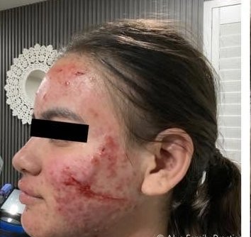 After treatment 1 — left profile