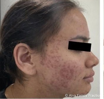 After treatment 2 — right profile