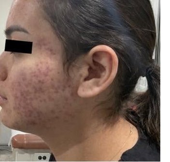 After treatment 2 — left profile
