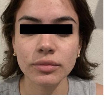 After treatment 3 — front view