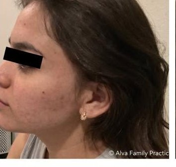 After treatment 3 — left profile