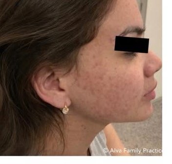 After treatment 3 — right profile