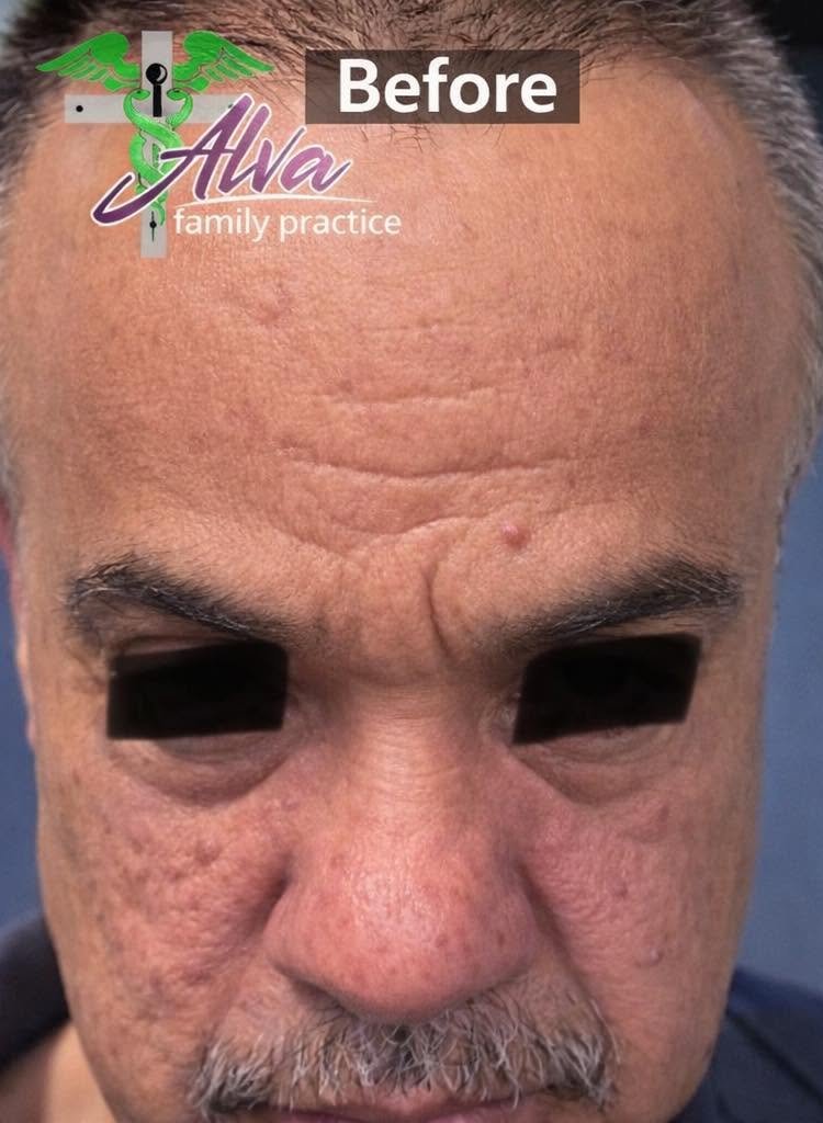 Before Morpheus8 — forehead wrinkles, under-eye bags and acne